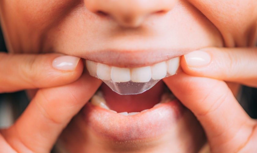 should you brush your teeth after using whitening strips