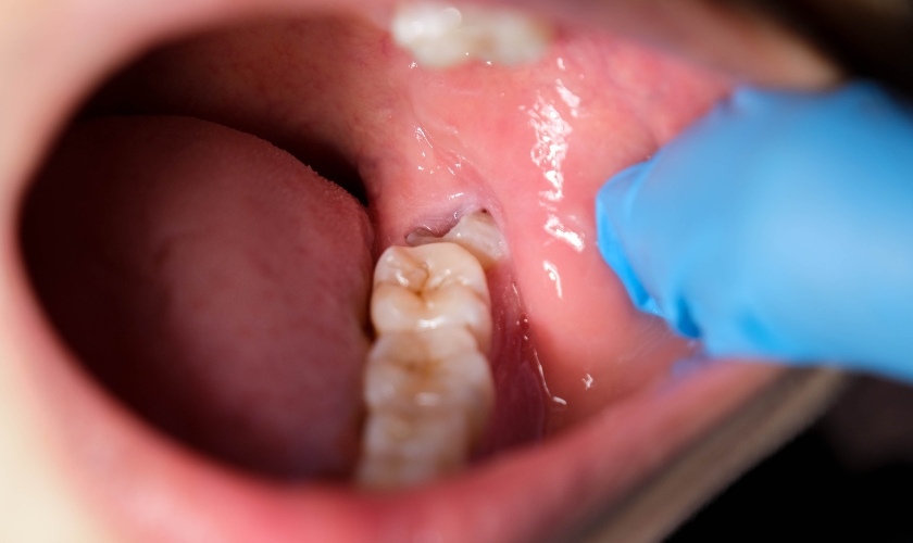 what happens if food gets stuck in your wisdom teeth holes