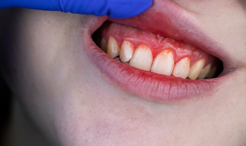 will i lose my teeth if i have periodontal gum disease