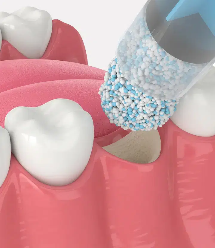 bone grafting metairie at gallagher family dentistry