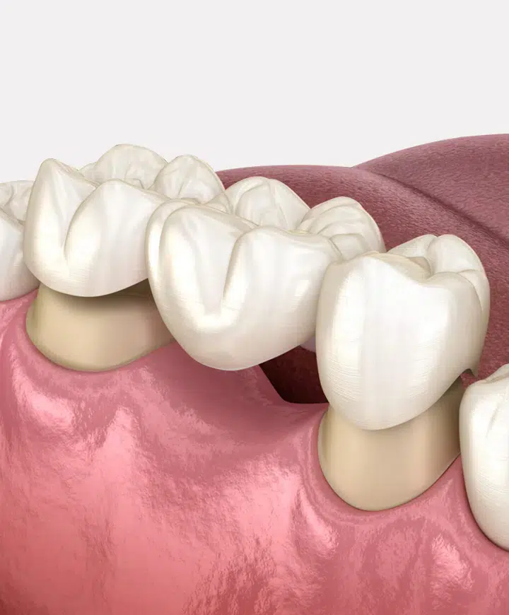 dental crowns & bridges in metairie at gallagher family dentistry