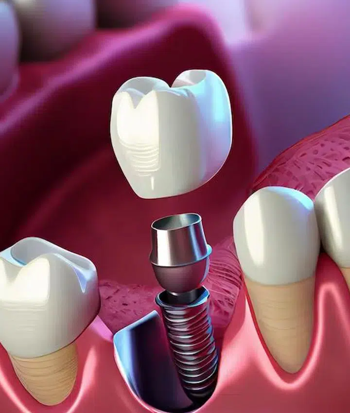 dental implants in metairie at gallagher family dentistry
