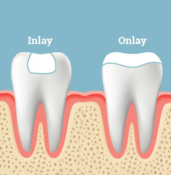 dental inlays and onlays metairie at gallagher family dentistry