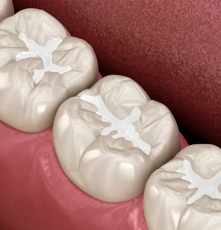 tooth colored fillings metairie at gallagher family dentistry