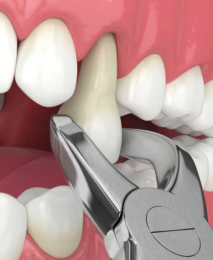 tooth extractions metairie at gallagher family dentistry
