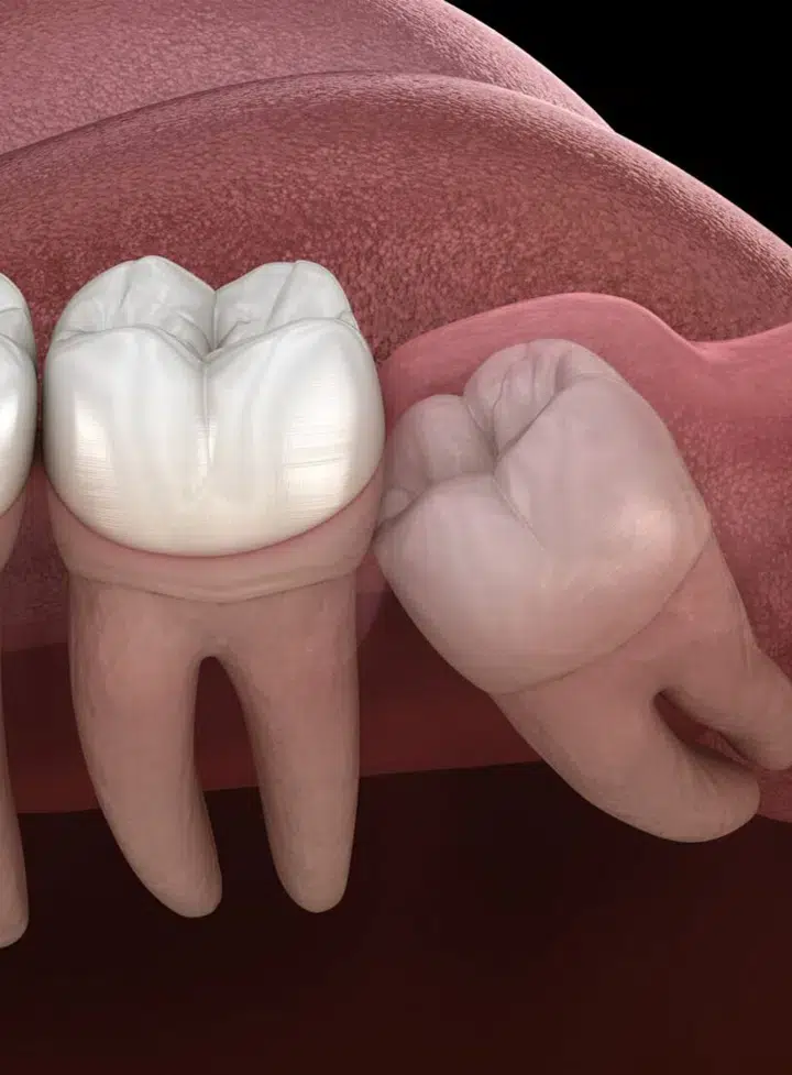 wisdom teeth removal metairie at gallagher family dentistry