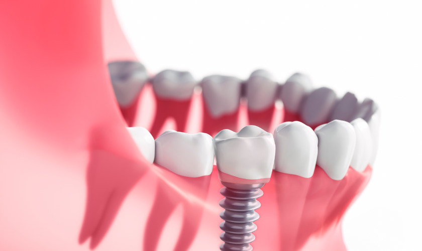 dental implants metairie