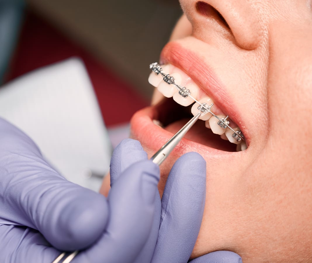 Dental Bridges in Kenner
