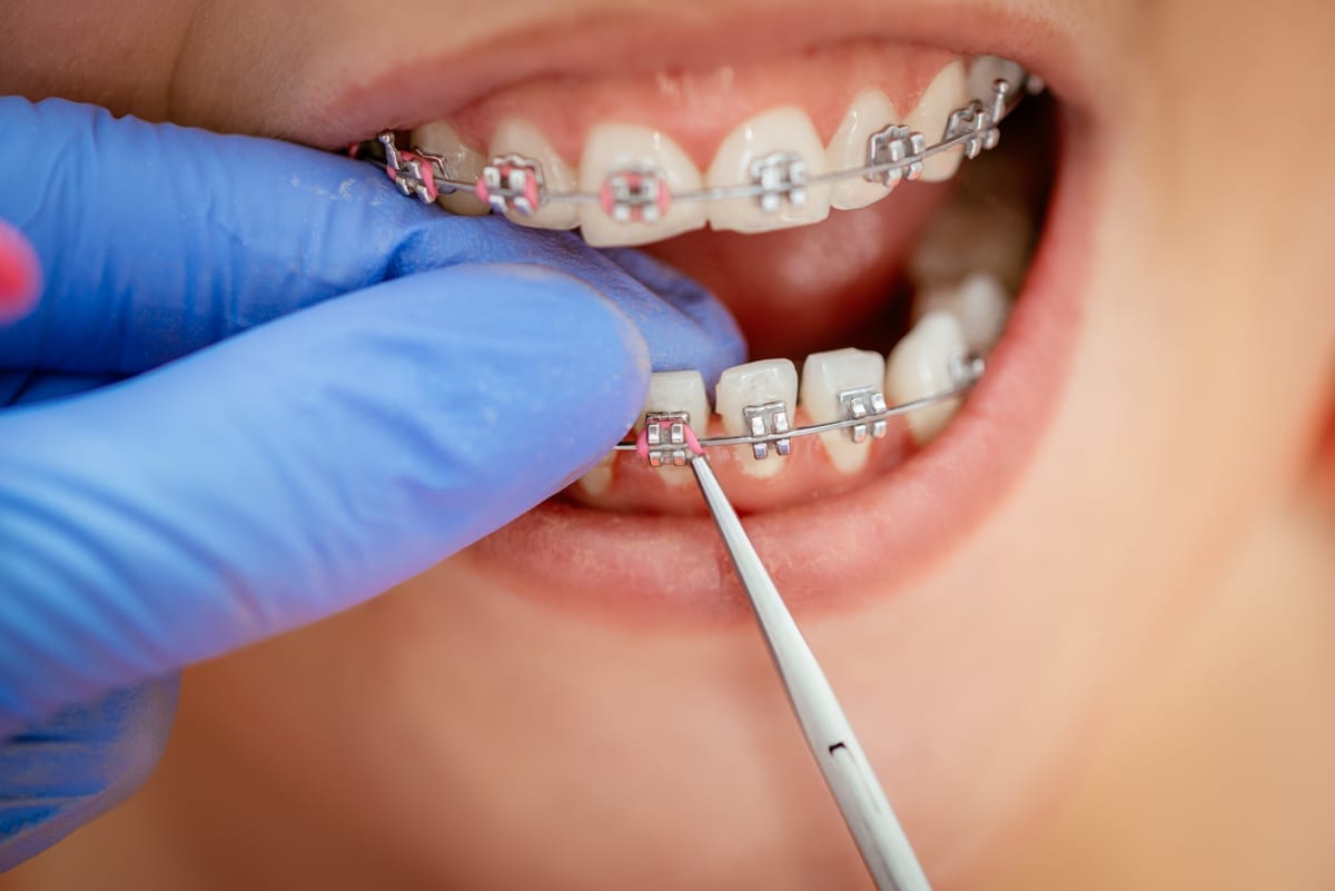 Dental Bridges in Metairie