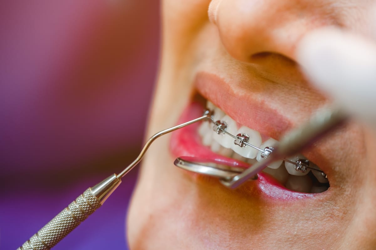 Dental Bridges in Kenner